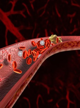 Arterial Embolectomy by OrangeCountySurgeons